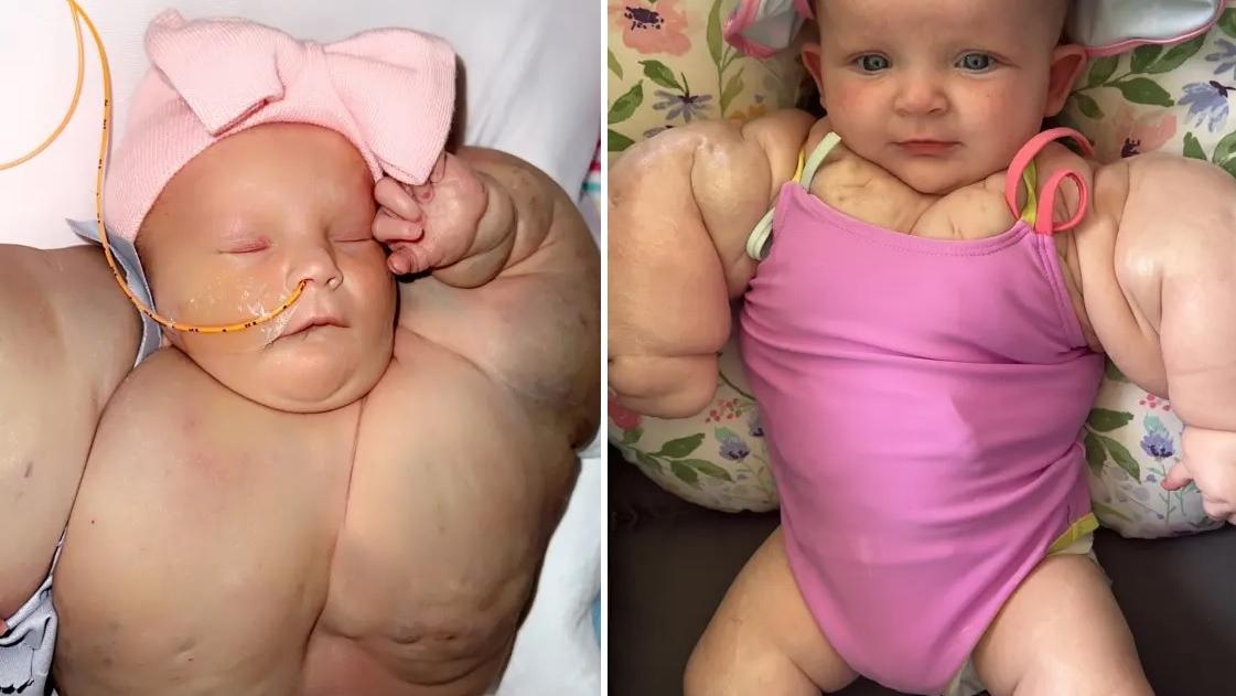 阿曼妮出生時身體腫脹，看來像「變形俠醫」，至今健康成長。(互聯網)