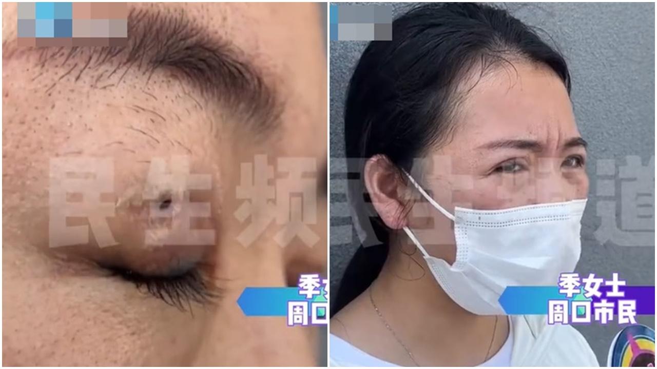 女子割雙眼皮後做修復，結果合埋眼發現「別有洞天」。(微博)