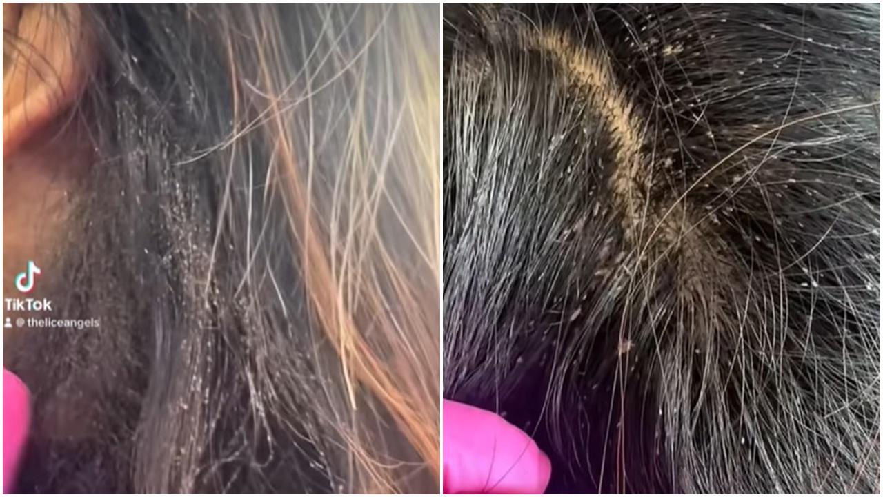 女孩頭髮上萬頭蝨亂竄，網民：睇到個頭好痕。(FB)