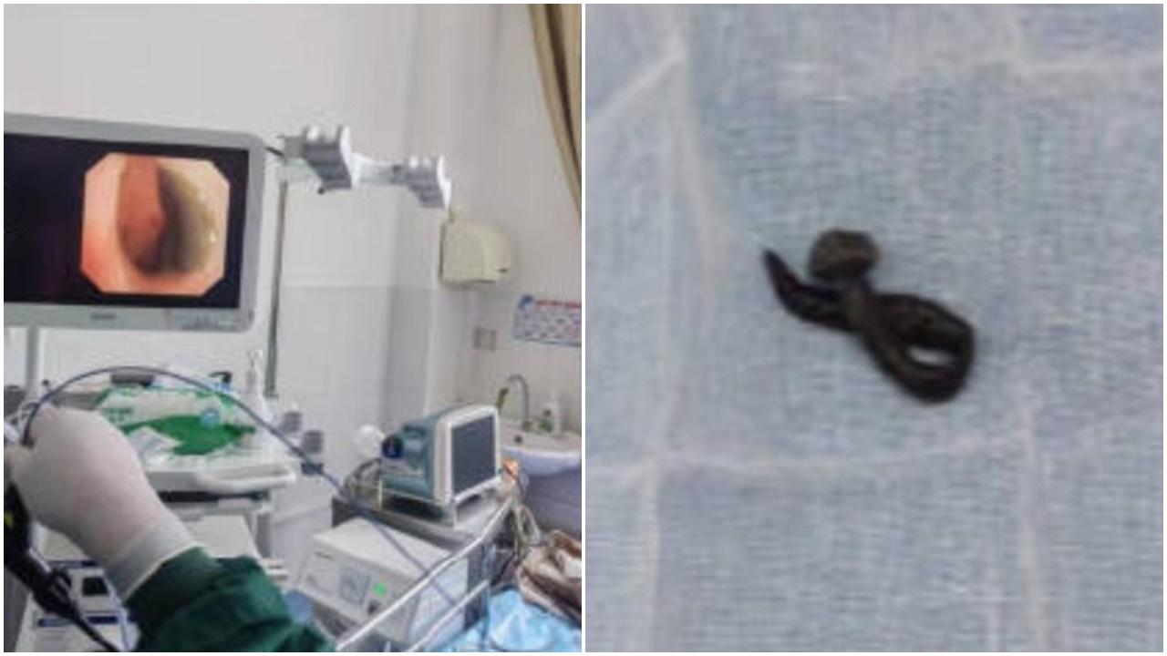 雲南婦咳痰帶血絲半個月，氣管竟取出8厘米水蛭。(網上圖片)