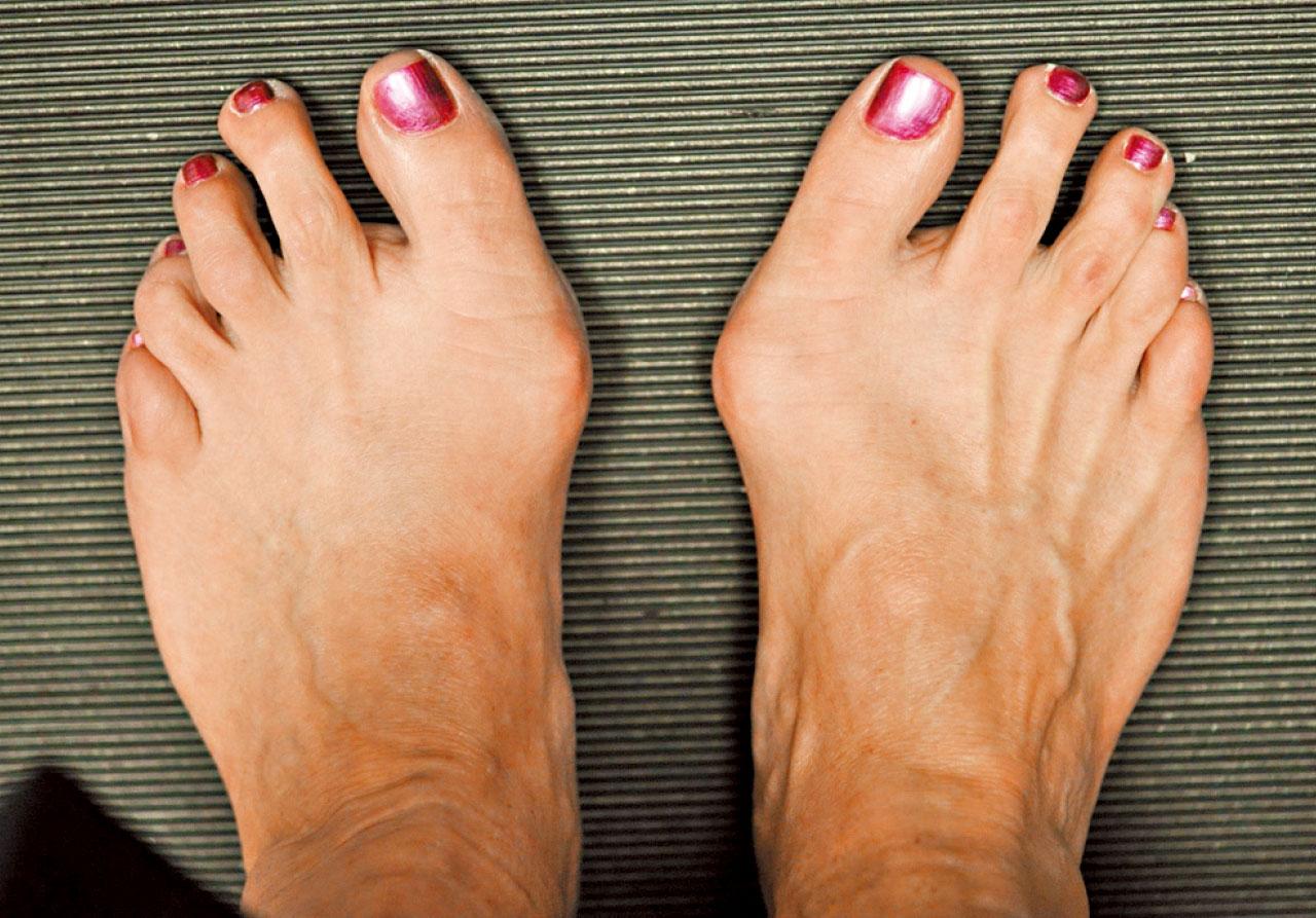 腳趾公痛 痛風定拇趾外翻？