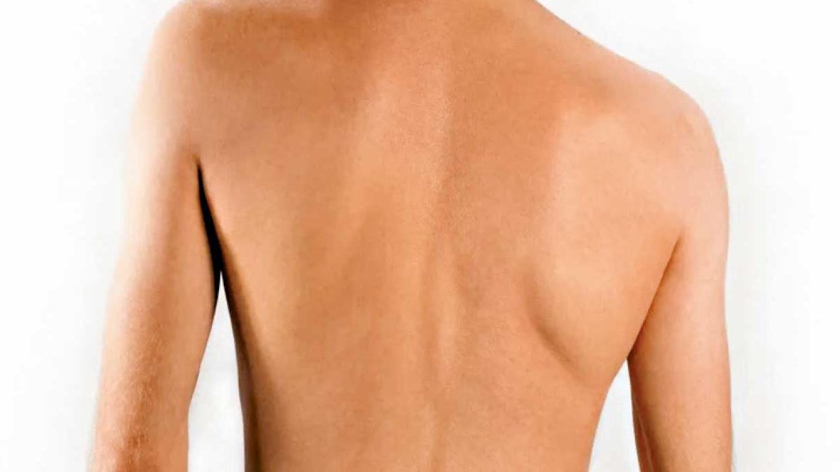 站姿不正可致脊柱側彎假「五十肩」