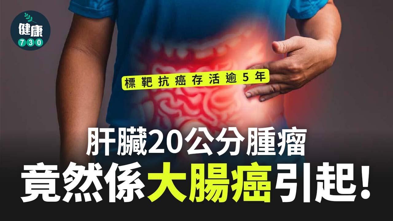 肝臟20公分腫瘤竟然係大腸癌引起！標靶抗癌存活逾5年