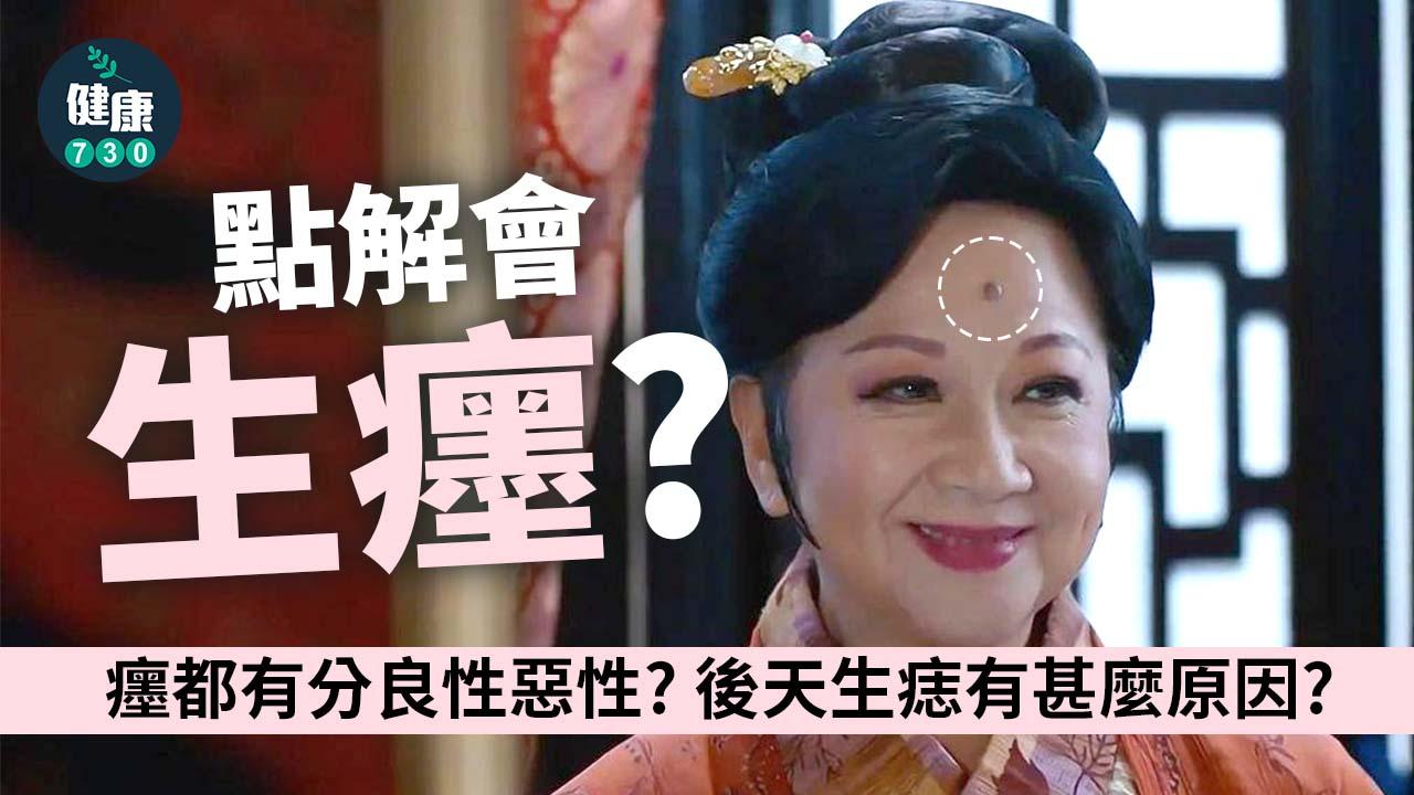 癦｜點解會生癦？天生還是後天形成？癦都有分良性惡性？