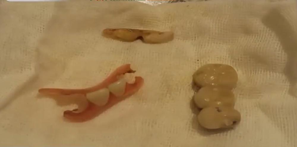 內地八旬翁胃病住院，因6隻牙及假牙套跌落胸肺致死。(微博)