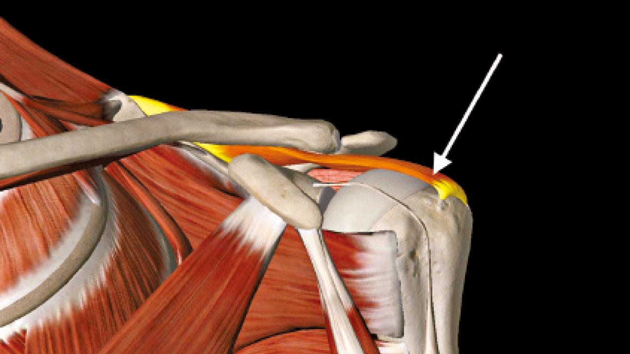 肩膊痛可以是肩袖撕裂