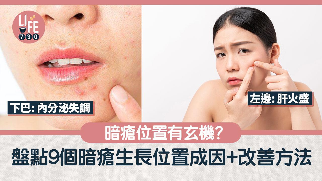 暗瘡位置有玄機？額頭、下巴、鼻頭等9個暗瘡生長位置成因+解決方法 