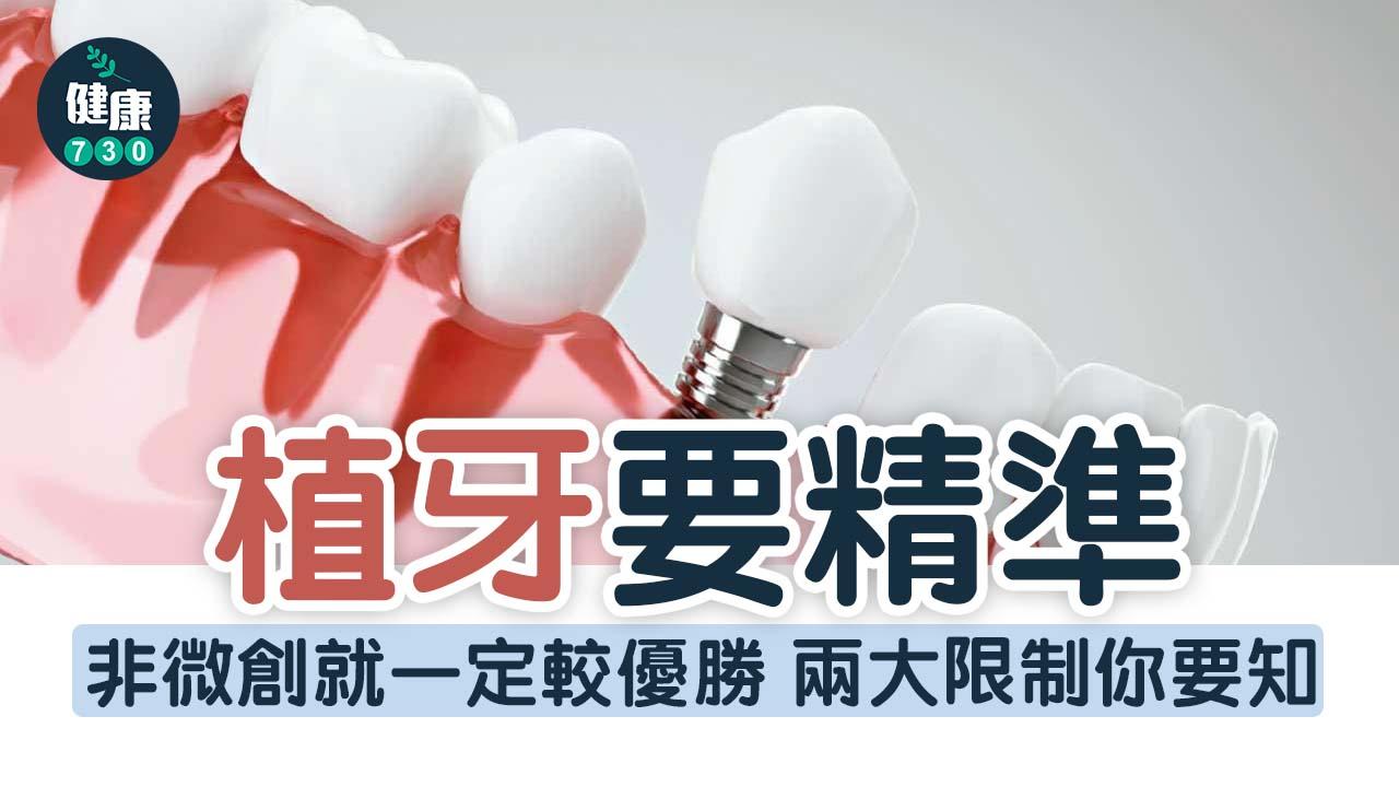 植牙要精準 不盲目求微創