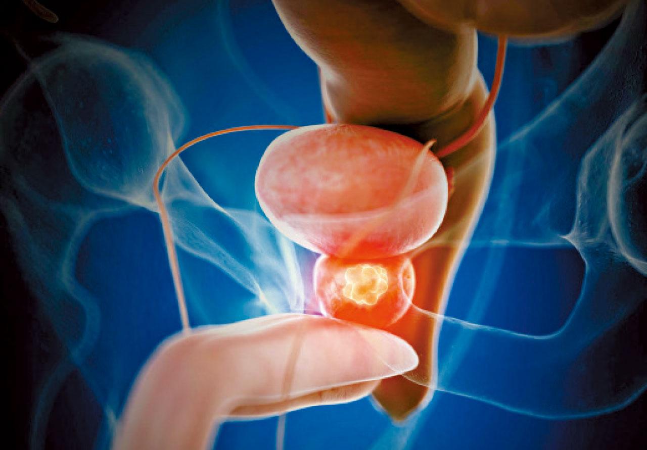 機械臂切除前列腺癌 保留性功能