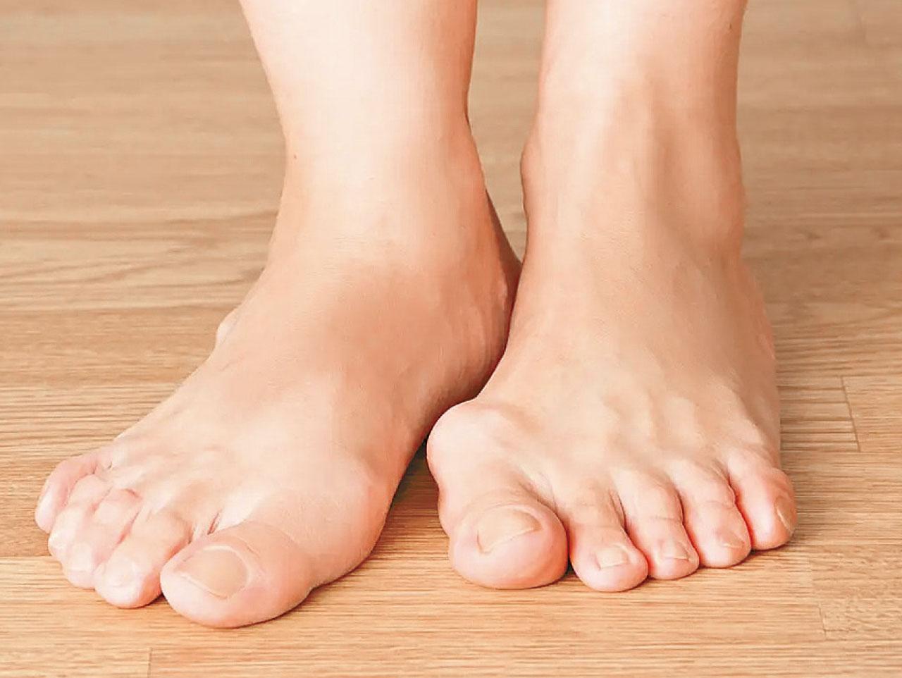 長者足部護理(四)：痛風症