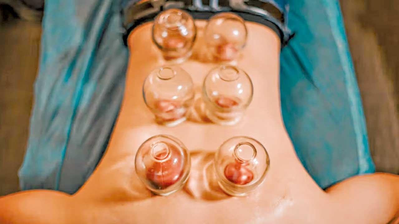 針罐結合 治療帶狀皰疹後遺神經痛