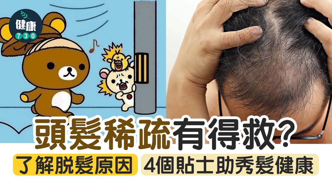 脫髮原因｜頭髮稀疏有得救？4招護髮方法守護髮線（am730）