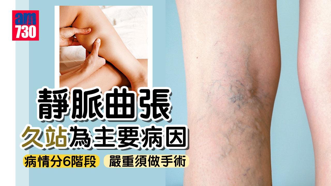 靜脈曲張原因｜症狀包括雙腳現青筋 病情分6個階段（am730製圖）