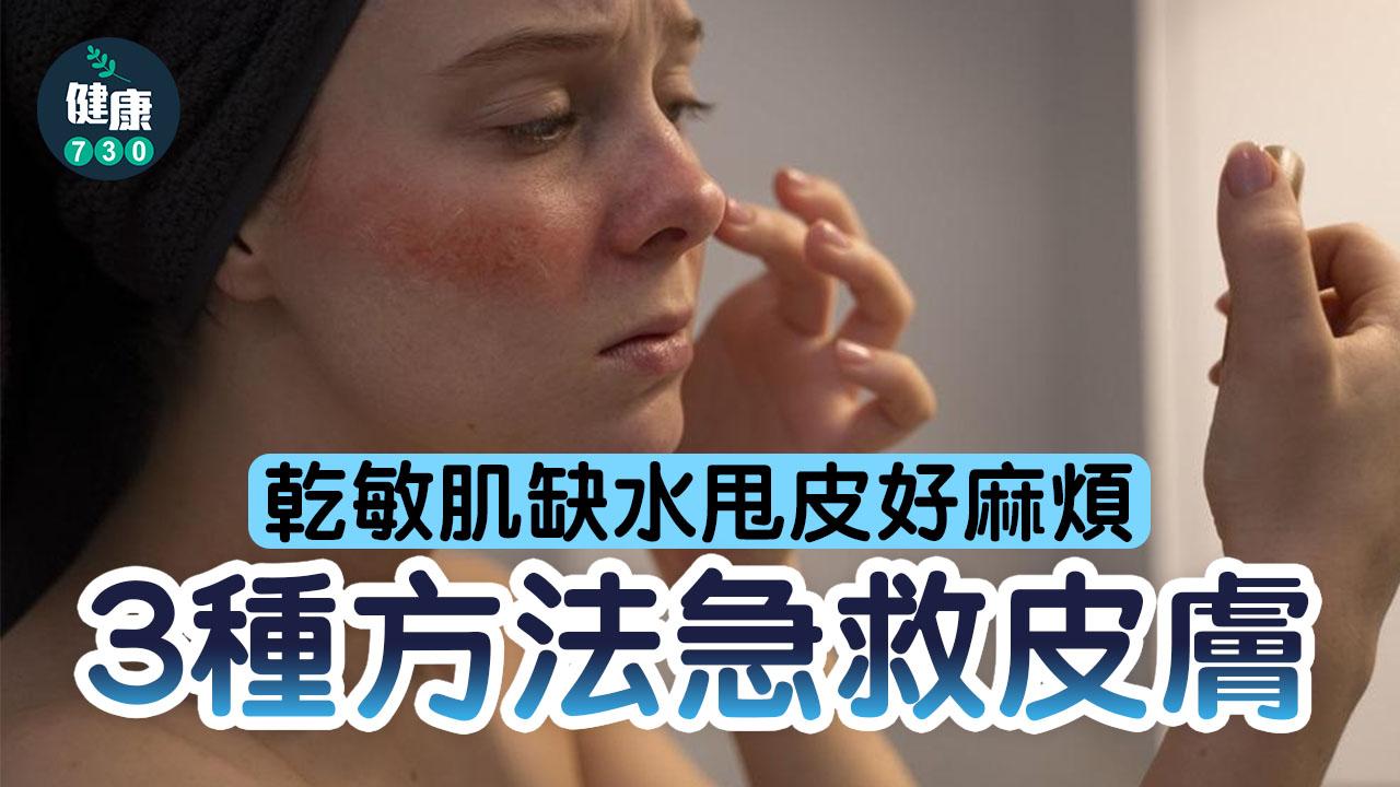 急救皮膚｜乾敏肌缺水甩皮好麻煩 除咗敷面膜仲可以試下水乳濕敷法