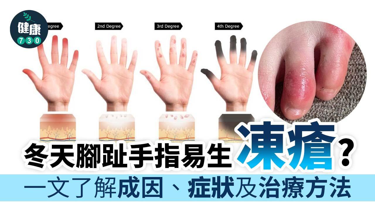 凍瘡成因、症狀及治療 一文了解冬天腳趾/手指易生「蘿蔔仔」及保暖方法（am730製圖）