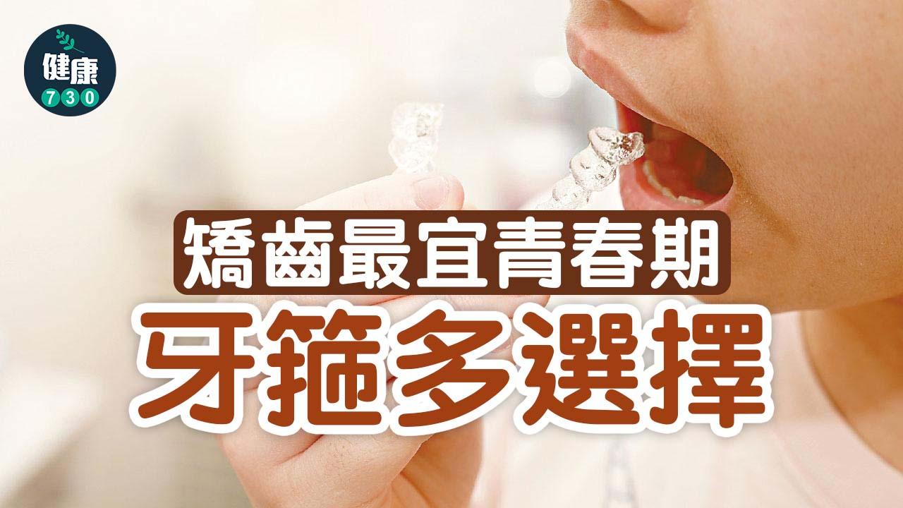 矯齒最宜青春期 牙箍多選擇