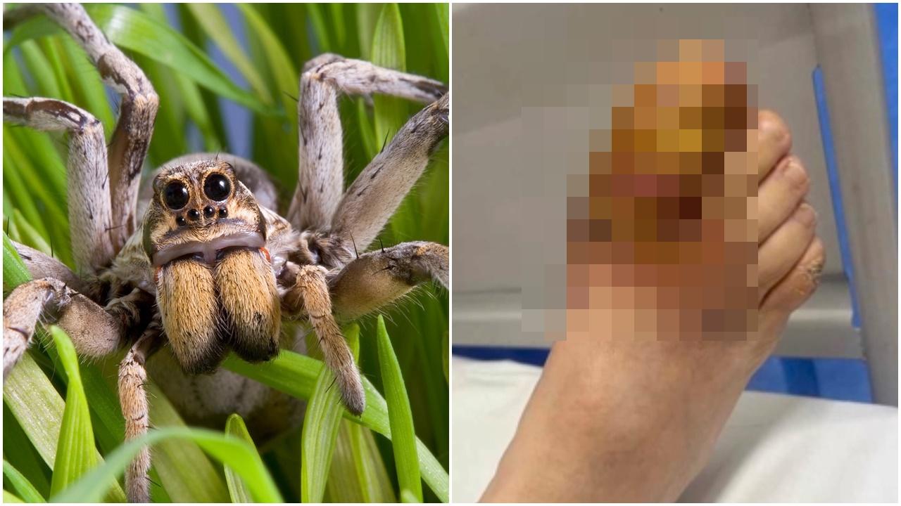 英漢去法國玩腳趾腫成紫色，切開驚見蜘蛛卵。