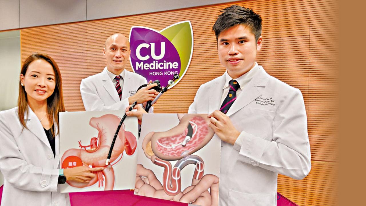 惡性胃出口阻塞 新手術助恢復消化道功能