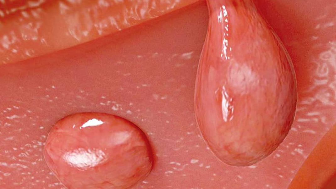 息肉小東西可能影響受孕？