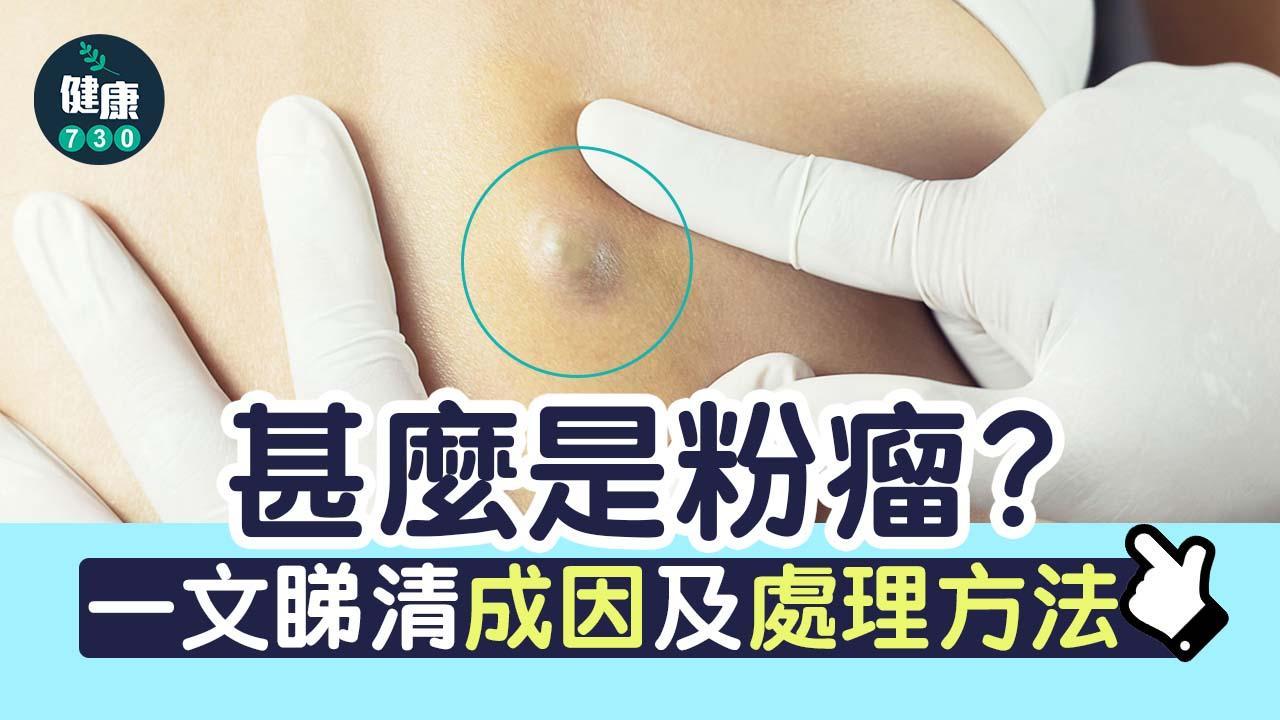 粉瘤成因｜甚麼是粉瘤？一文睇清表皮樣囊腫處理方法（am730製圖）