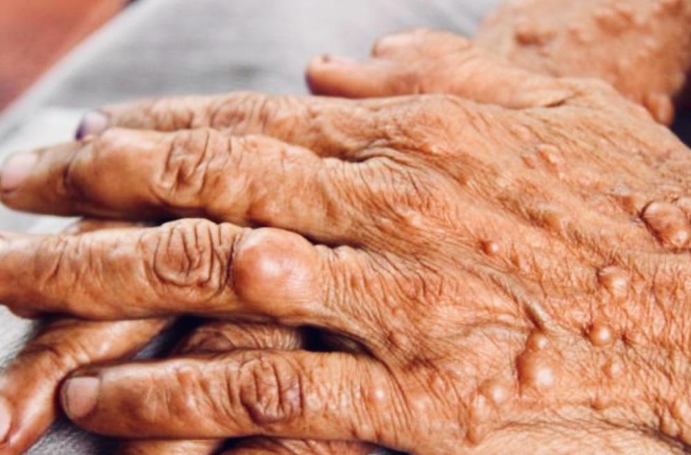 多發性軟組織腫瘤