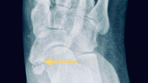 副舟狀骨 附生骨