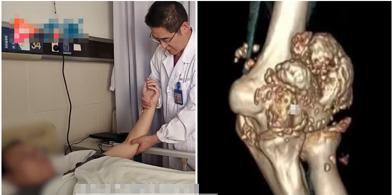 長沙26歲男每日熬夜打機10小時  手肘生出過千粒「珍珠」