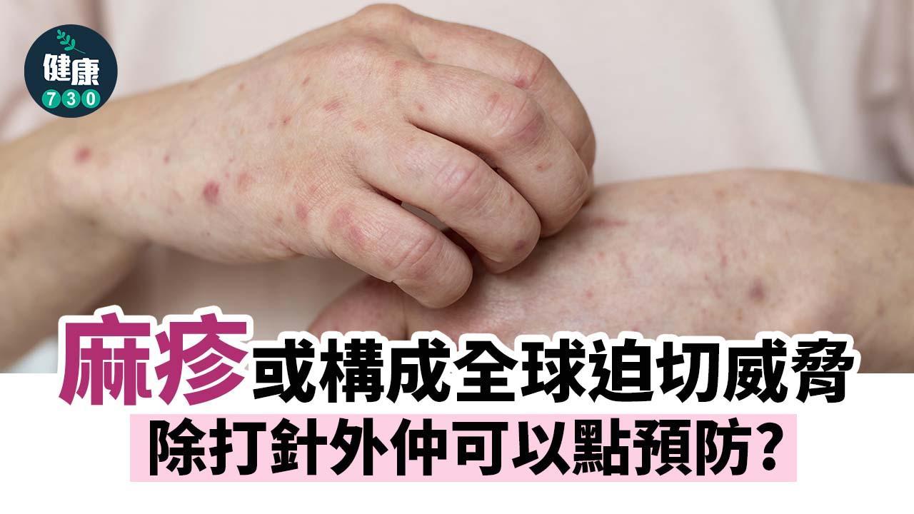 麻疹病徵係乜？疫苗以外要勤洗手保持個人衛生預防染病（am730製圖）