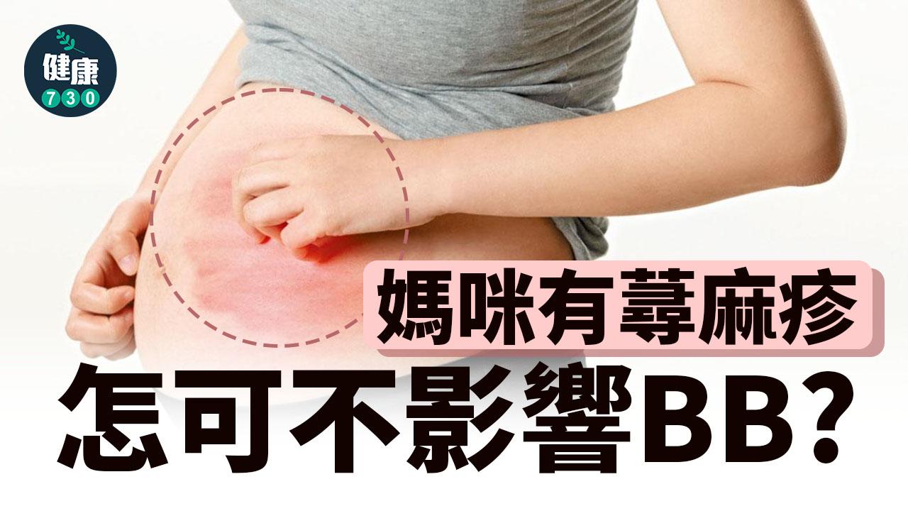 蕁麻疹｜媽咪有蕁麻疹 怎可不影響BB？