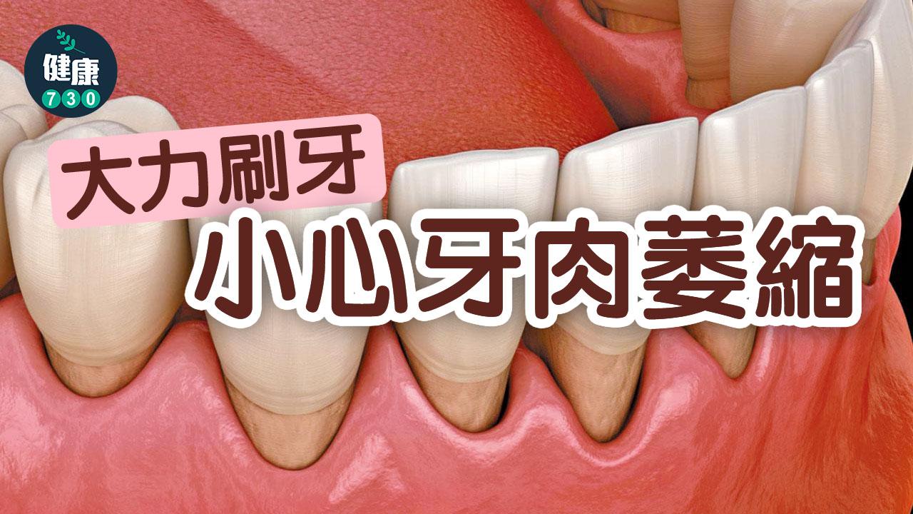 大力刷牙 小心牙肉萎縮