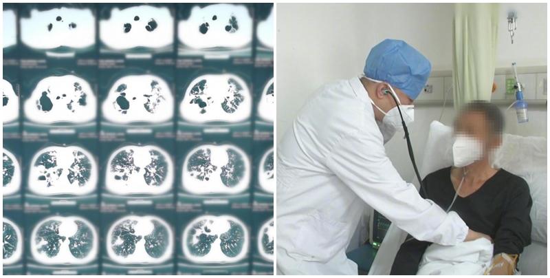 湖北一名53歲男子20年來為提神，每日狂食10包煙（200支），近日因出現嚴重呼吸困難入院。經檢查後發現，他的肺部已經千瘡百孔，醫生更表示：「（肺部）上半截幾乎都爛掉。」最終他聽從勸告戒煙。