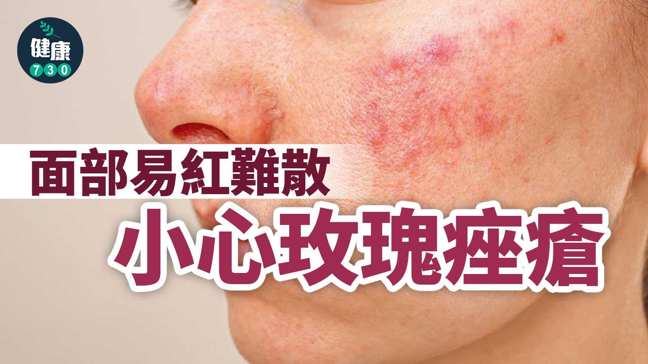 面部易紅難散 小心玫瑰痤瘡