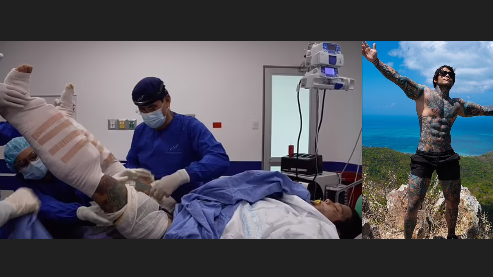 增高方法｜29歲網紅親試「全球最痛手術」斷骨增高4吋︰痛到晚晚瞓得兩個鐘！