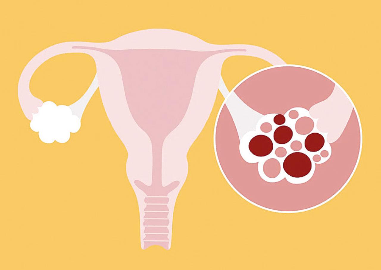 胖多囊與瘦多囊的分別？