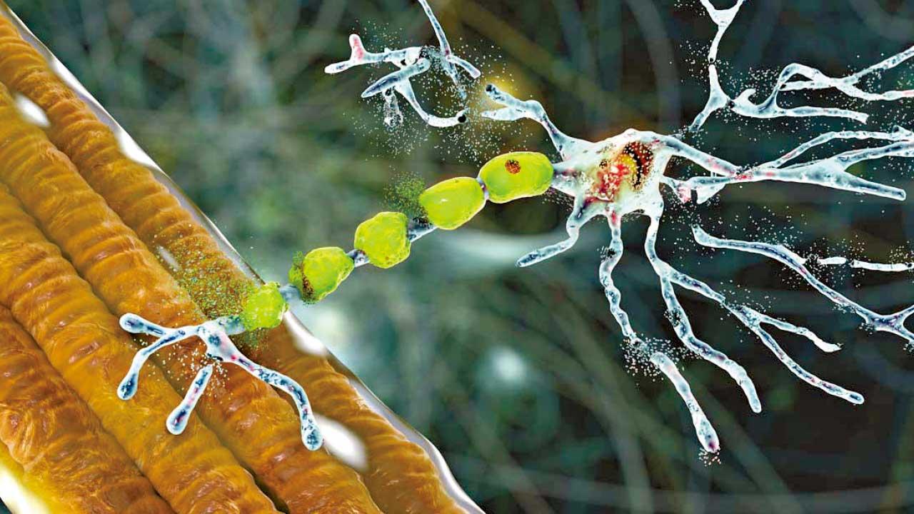 找出ALS病理機制 助研發治療方法