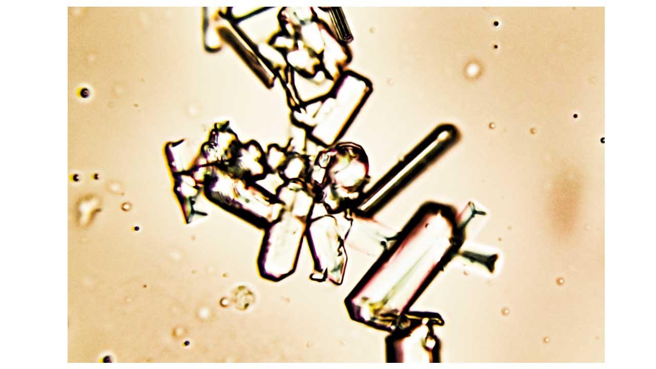 尿酸結晶的形成：揭開嘌呤的奧秘
