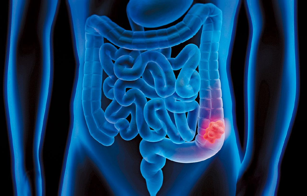 大腸癌致腸塞 先支架後手術 免開造口