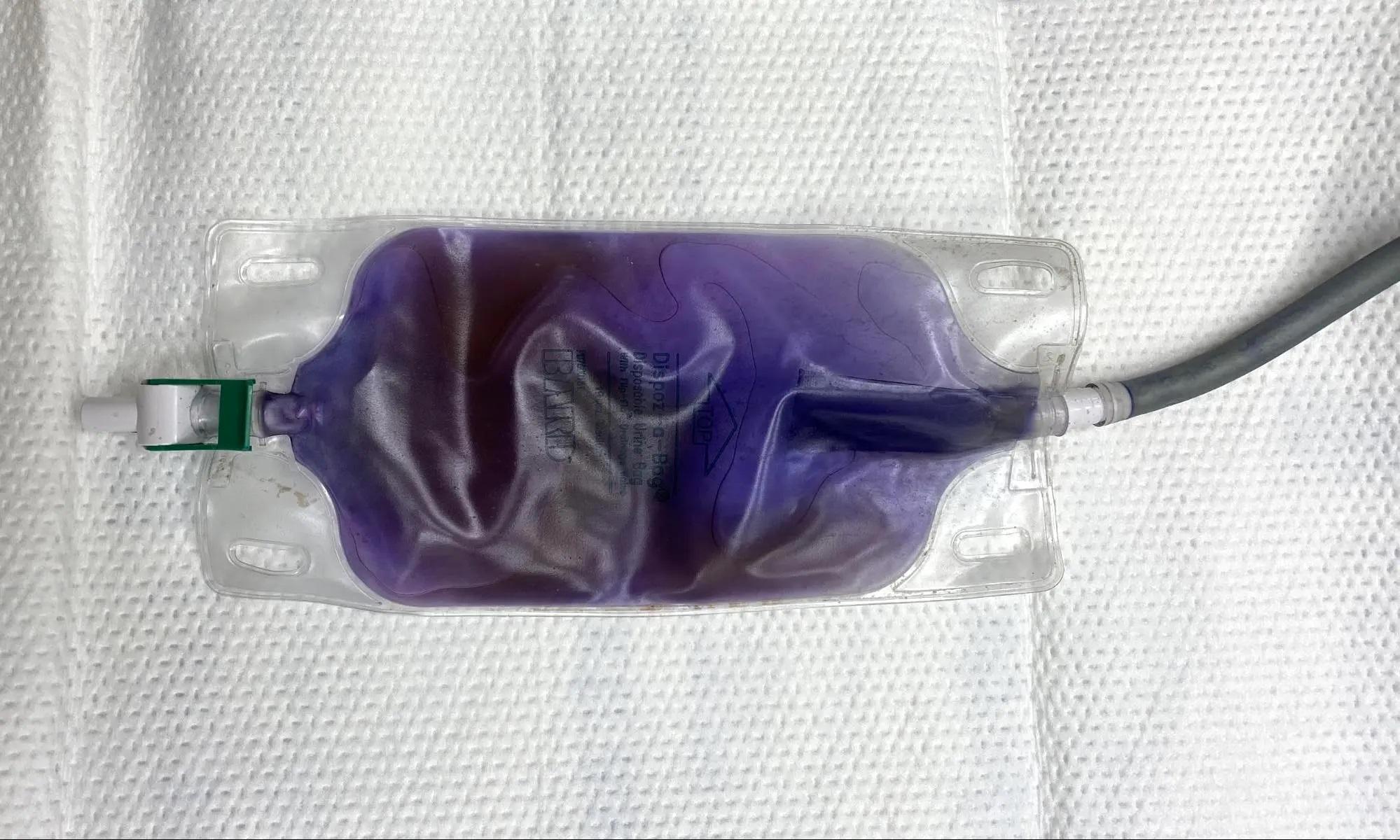 紫色尿袋症候群