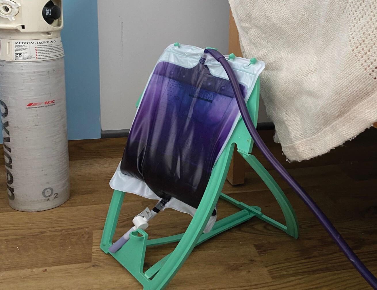 紫色尿袋症候群