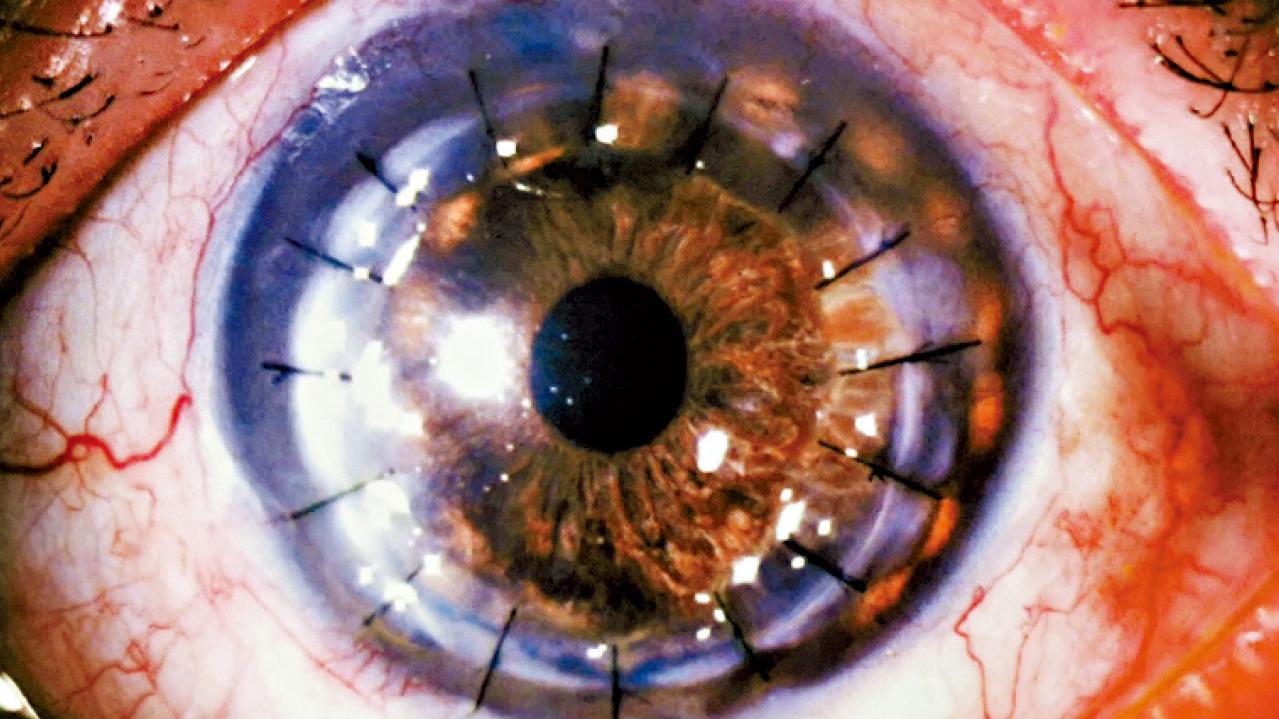 以眼換眼— 關於角膜移植的那些事 