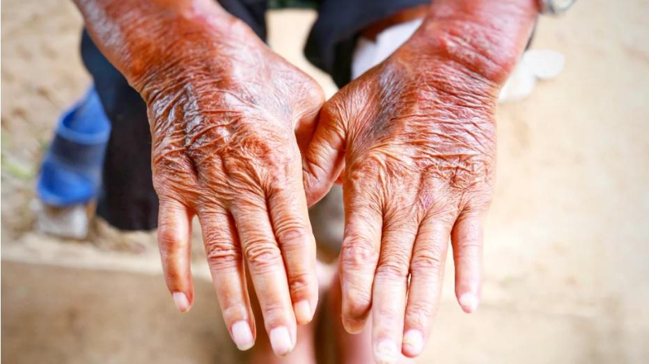 【硬皮症】了解初期症狀、飲食須知、壽命及保險保障（附照片）