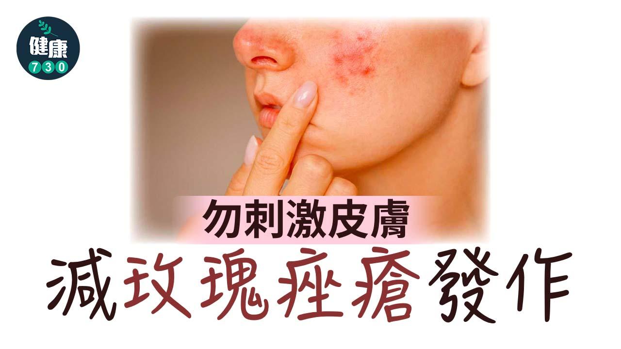 勿刺激皮膚 減玫瑰痤瘡發作