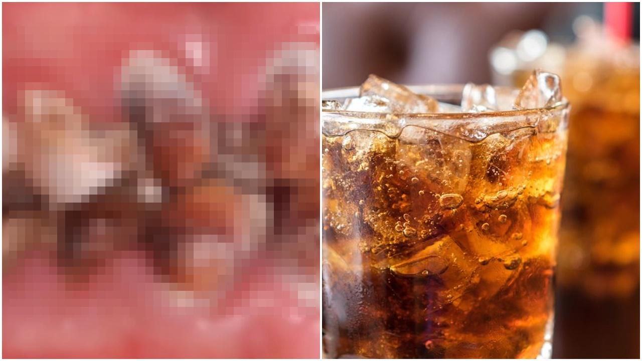 可樂當水飲1年，22歲女滿口爛牙一碰就甩。(微博)