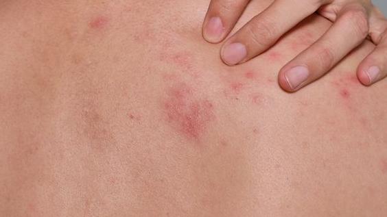 5旬男吃感冒藥皮膚剝落糜爛　禍首竟是兩周前服用的藥物