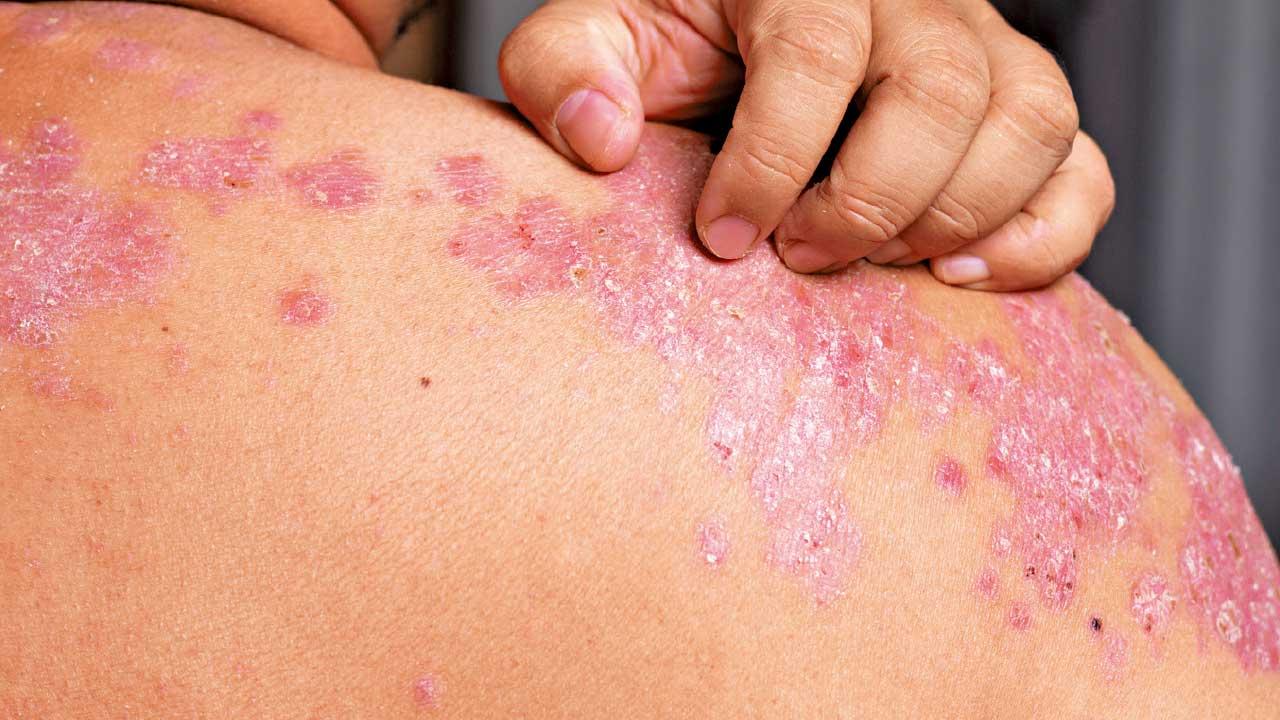 88%銀屑病患者停藥後惡化  治療應長治久安