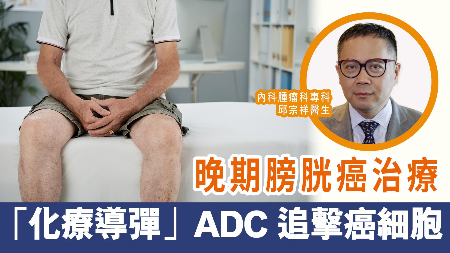 晚期膀胱癌治療——「化療導彈」ADC 追擊癌細胞