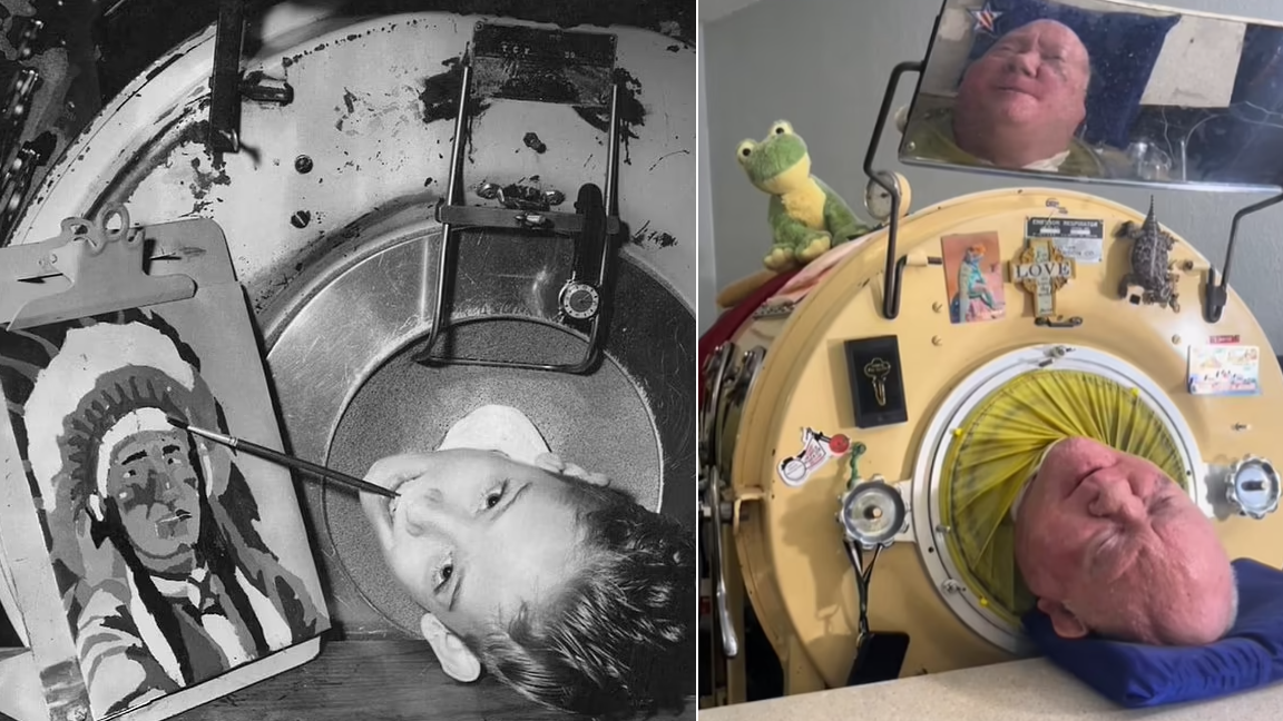 被困「鐵箱」逾70年 美鐵肺男逝世終年78歲 回顧一生 癱瘓仍當上律師作家(有片)