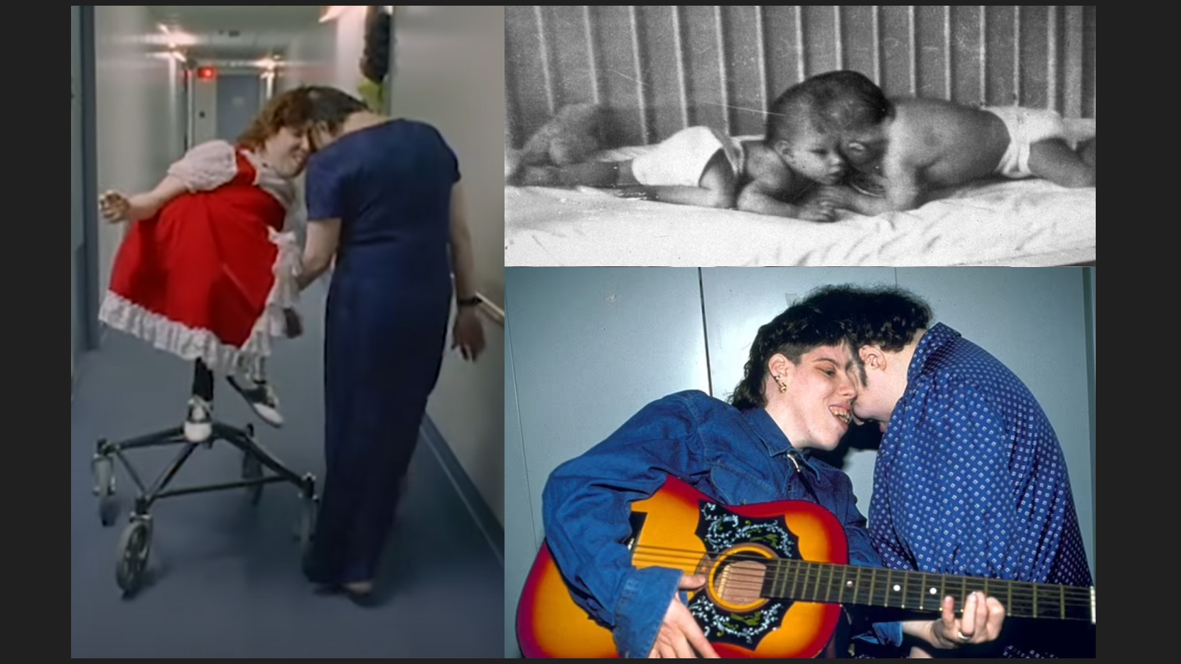 國際專題｜全球最長壽連體嬰逝世 62年人生怎麼過？