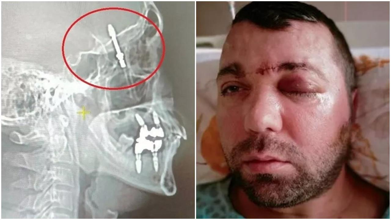 無良牙醫植牙插穿顎骨，病人被丟醫院險送命。