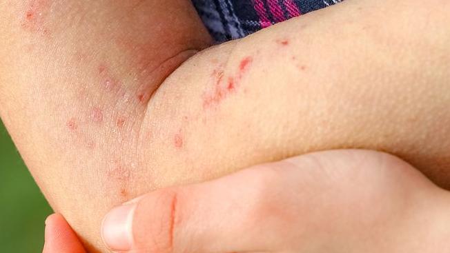 「異位性皮膚炎」狂抓恐致傷口惡化、感染！　醫教１招有效控制病況